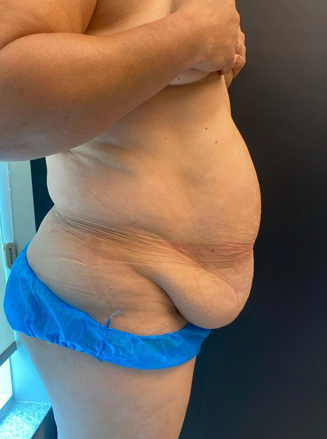 lipo depois lipo depois