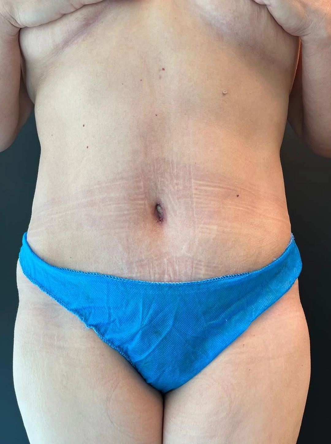 lipo depois11 lipo depois11